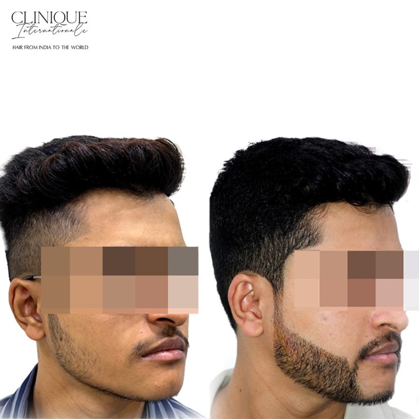 Patchy beard growth in men