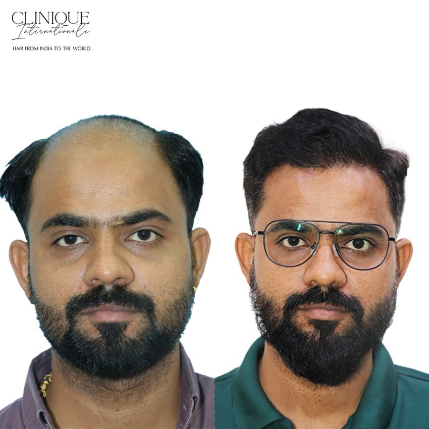 Hair Transplant in Dehradun