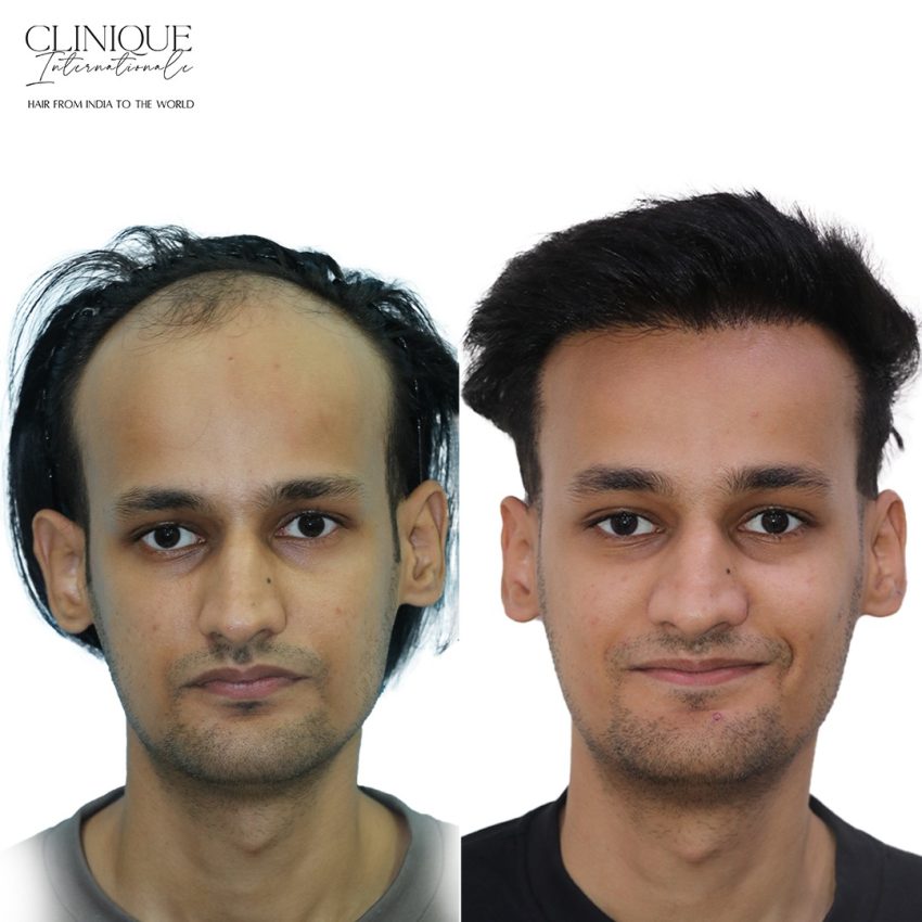 Hair Transplant in Lucknow