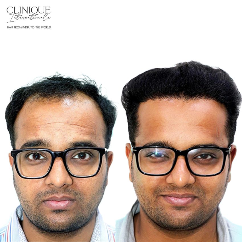 Natural Hairline Transplant in Shirdi